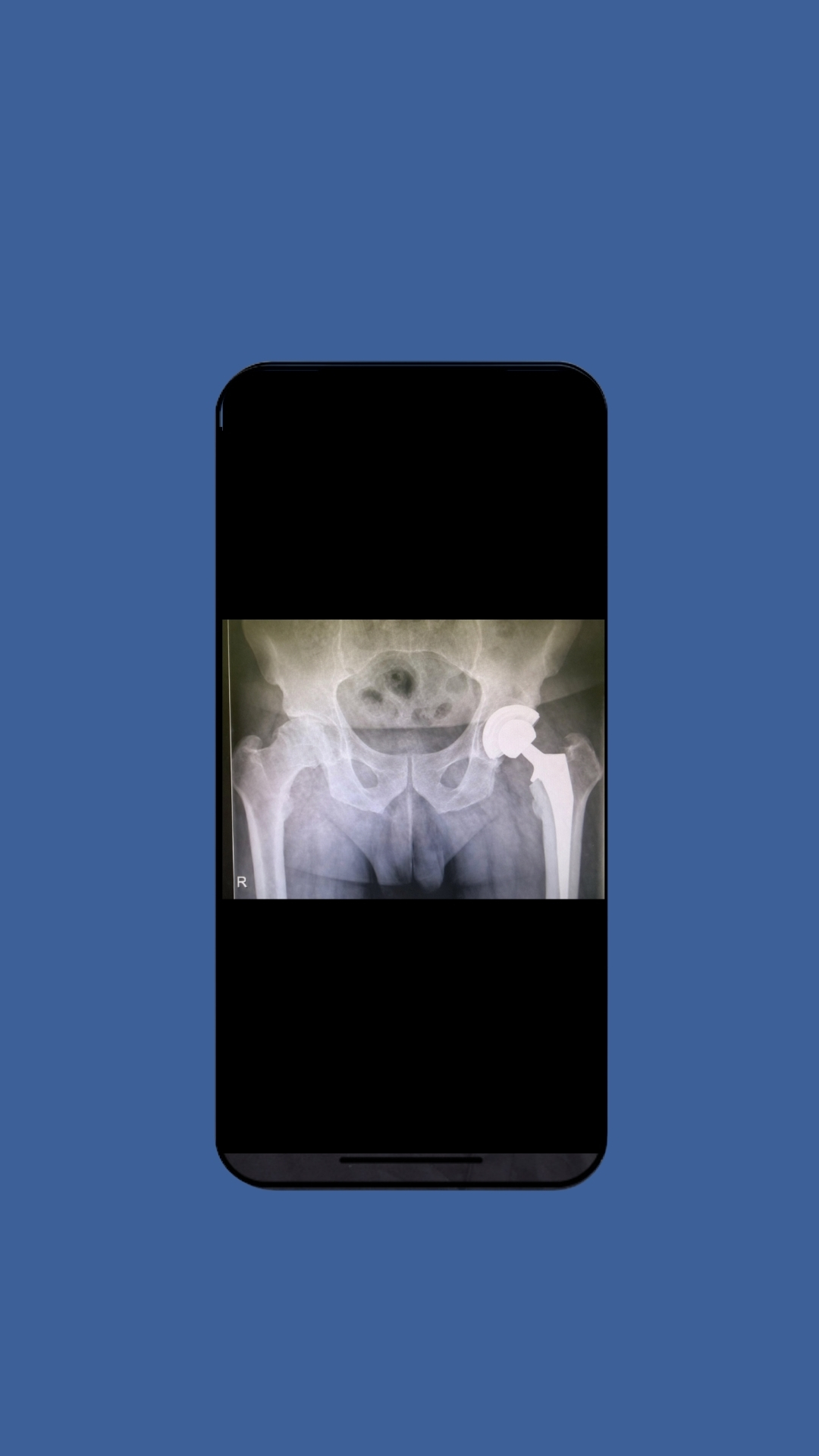 Hoftekirurgi – røntgen av hofte Røntgenbilde av hofte med proteseimplantat – illustrasjon av hoftekirurgi