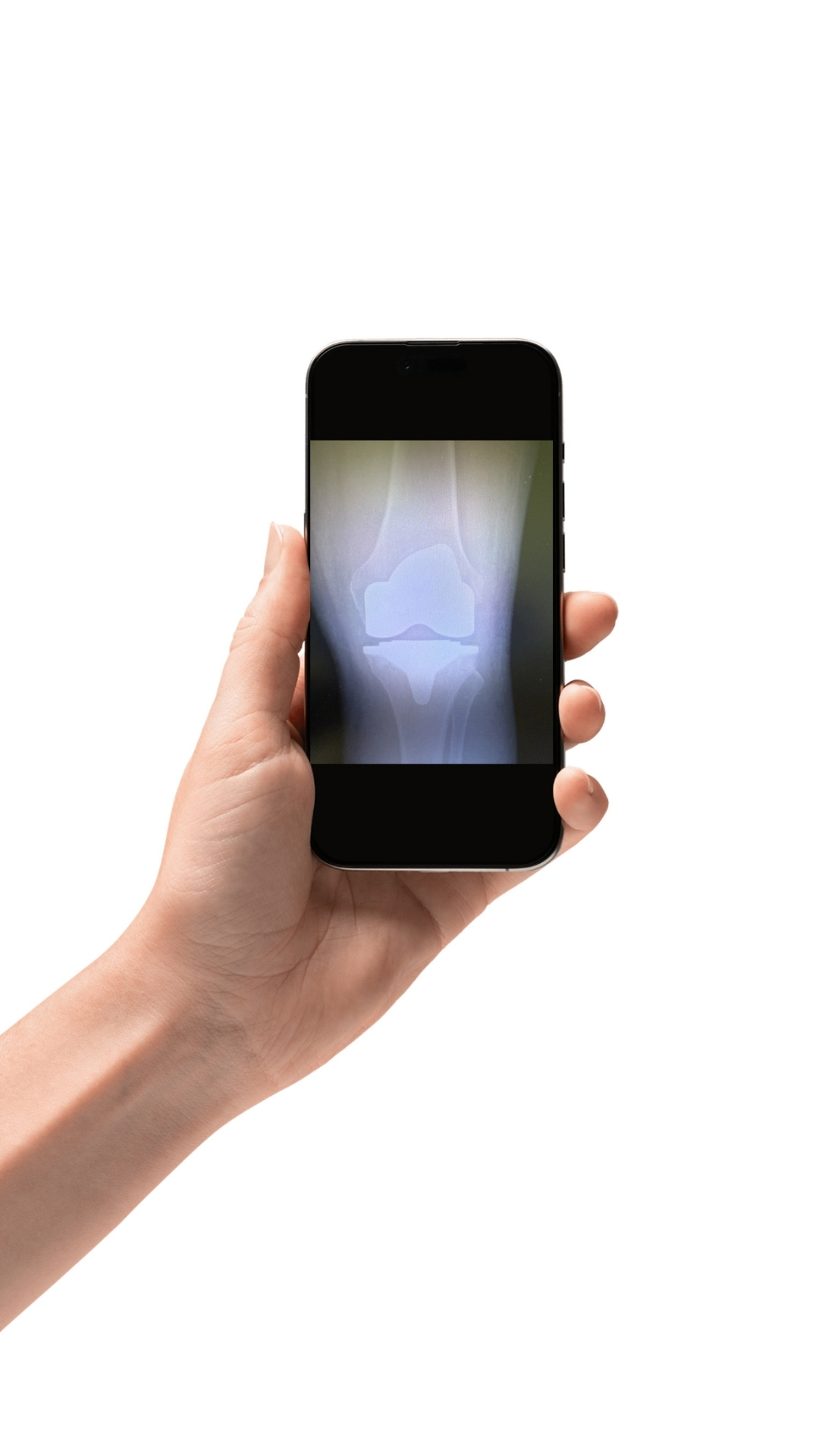 Knekirurgi – røntgen av kne Røntgenbilde av kne vist på mobilskjerm – illustrasjon av knekirurgi